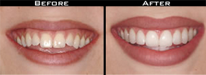 Dental Crown before and after