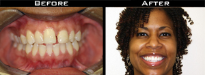 Dental Crown Before/After Photo