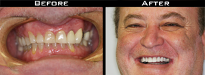 Dental Crown Before/After Photo