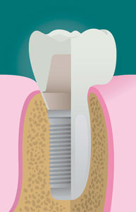 Dental Implant