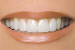Quick and Painless Smile Makeovers