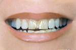 Quick and Painless Smile Makeovers