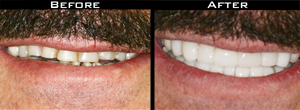 Smile Gallery - Before and After
