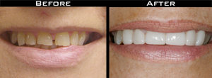 Smile Gallery - Before and After