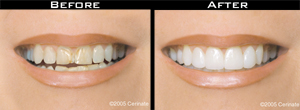 Smile Gallery - Before and After