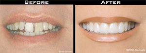 Smile Gallery - Before and After