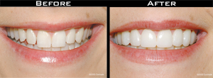 Smile Gallery - Before and After