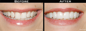 Smile Gallery - Before and After