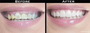 Smile Gallery - Before and After