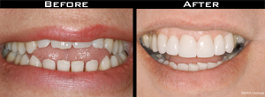 Smile Gallery - Before and After