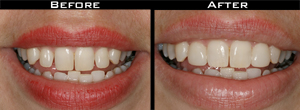 Smile Gallery - Before and After