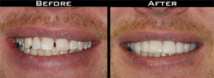 Smile Gallery - Before and After