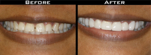 Smile Gallery - Before and After