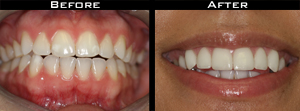 Veneer Before/After Photo