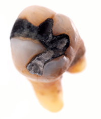 Amalgam Silver Filling