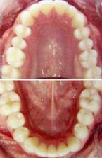 Get Perfectly Straight Teeth with Braces and Invisalign Orthodontics