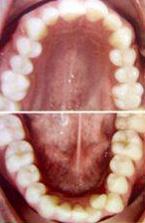 Get Perfectly Straight Teeth with Braces and Invisalign Orthodontics