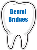 Dental Bridges