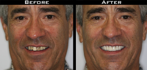 Dental Crown before and after