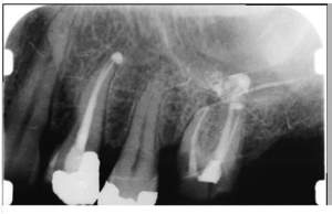 Root Canal