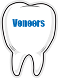 Veneers