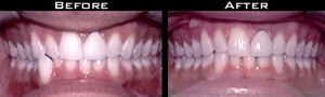 Invisalign Before and After Photo Case 1