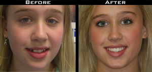 Invisalign Before and After Photo Case 5