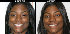 Invisalign Before and After Photo Case 5