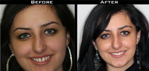 Invisalign Before and After Photo Case 5