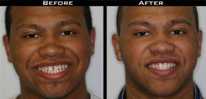 Invisalign Before and After Photo Case 5