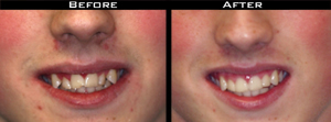 Invisalign Before and After Photo Case 5