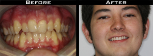 Invisalign Before and After Photo Case 5