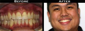 Invisalign Before and After Photo Case 5