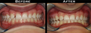 Invisalign Before and After Photo Case 5