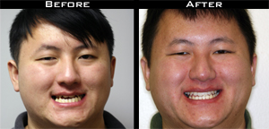 Invisalign Before and After Photo Case 5