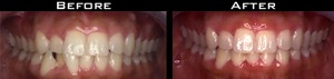 Invisalign Before and After Photo Case 2