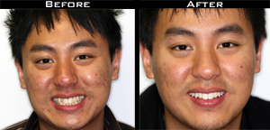 Invisalign Before and After Photo Case 5