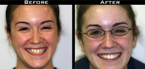 Invisalign Before and After Photo Case 5