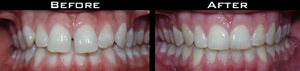 Invisalign Before and After Photo Case 3