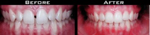 Invisalign Before and After Photo Case 4