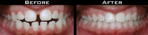 Invisalign Before and After Photo Case 5