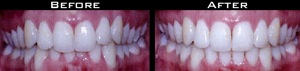 Invisalign Before and After Photo Case 6