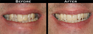 Invisalign Before and After Photo Case 5