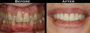 Invisalign Before and After Photo Case 5